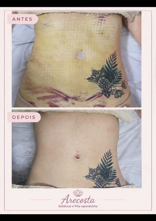 Antes e depois pós-operatório