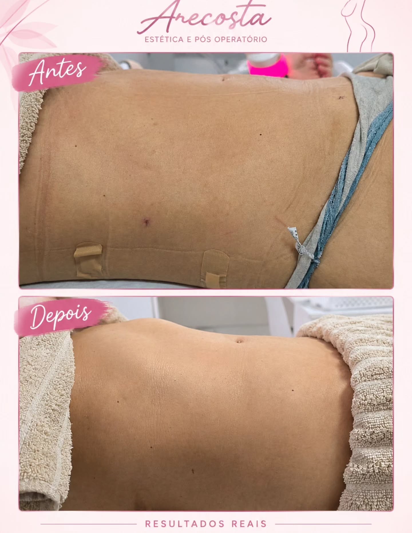 Antes e depois pós-operatório