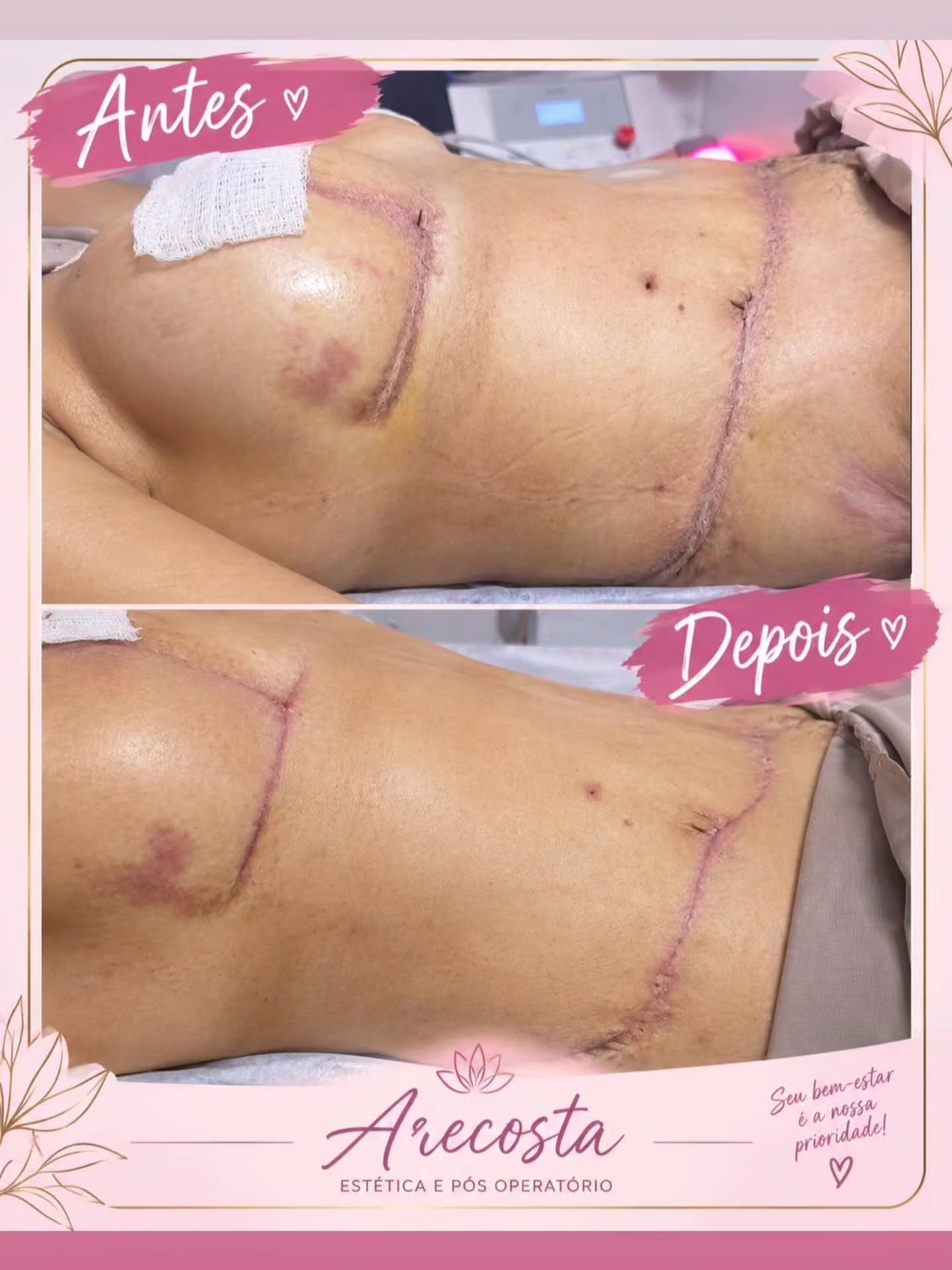 Antes e depois pós-operatório
