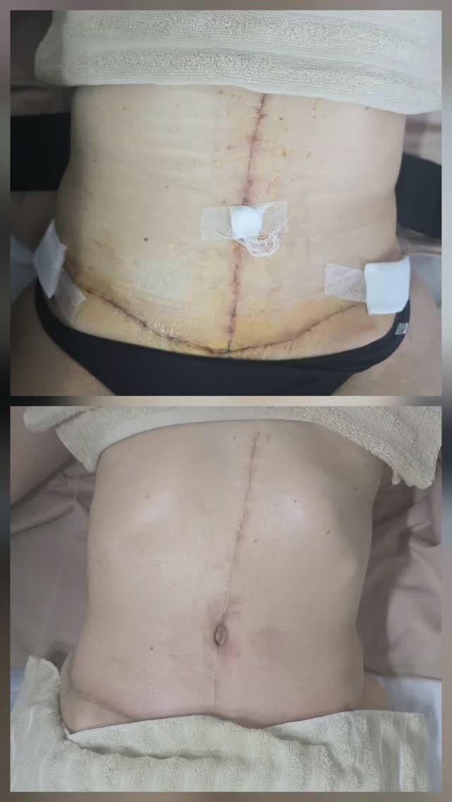 Antes e depois pós-operatório